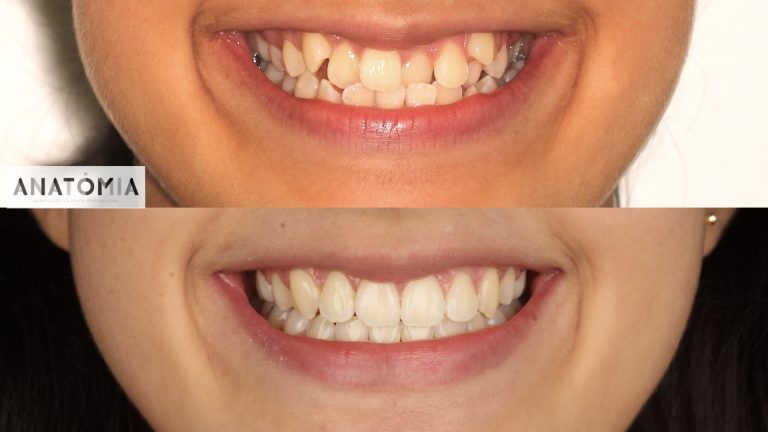 Caso clínico ortodoncia adolescente - antes y después