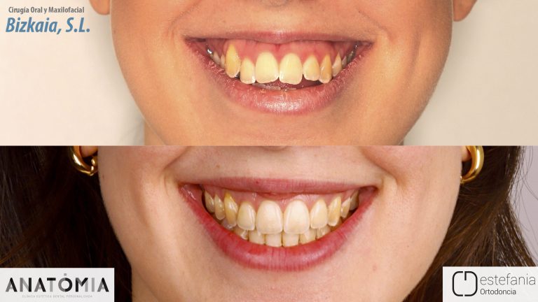 Caso clínico cirugía ortognática adulto - antes y después
