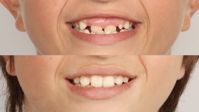 Caso clínico ortodoncia interceptiva infantil - antes y después