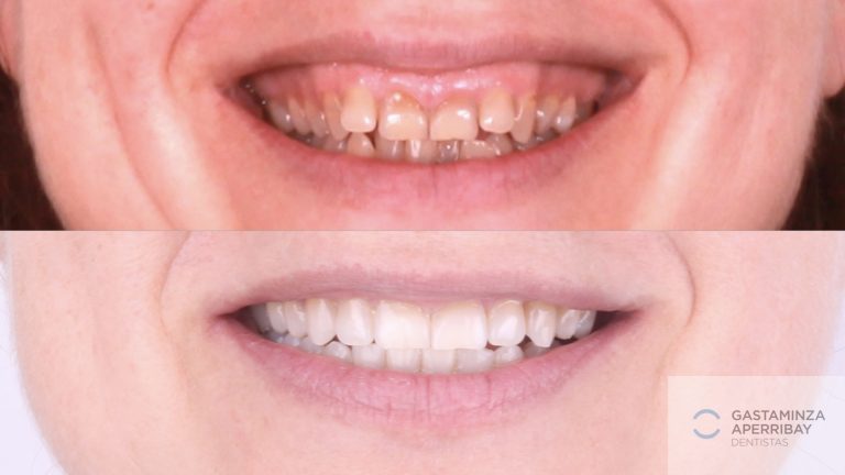 Caso clínico Invisalign y blanqueamiento adulto - antes y después