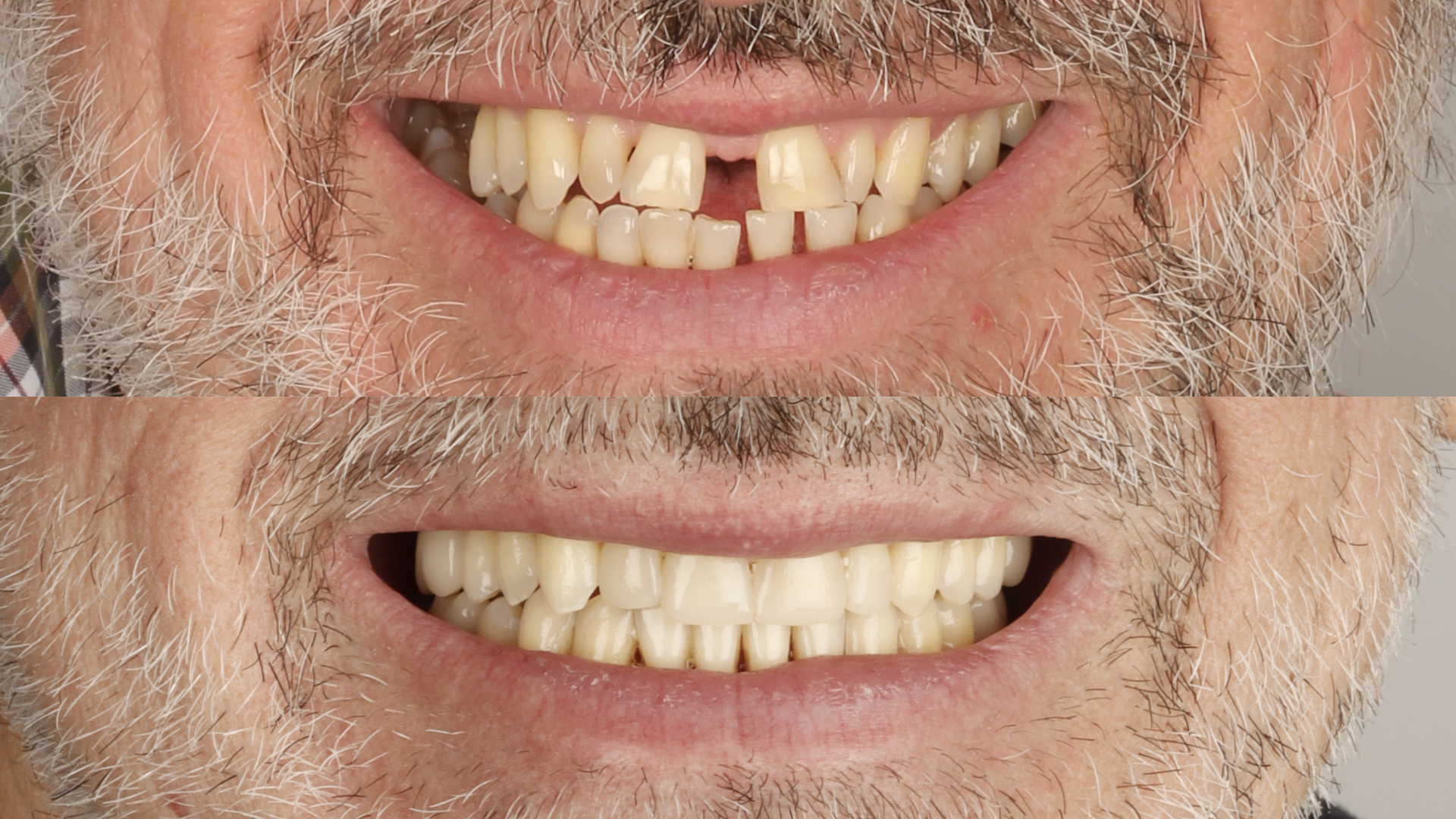 Caso clínico rehabilitación oral con implantes, estética e Invisalign - antes y después