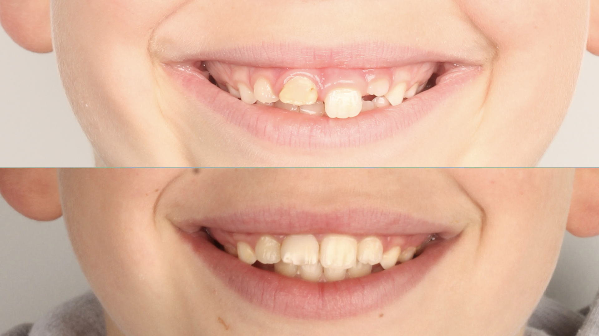 Caso clínico ortodoncia en traumatismo dental infantil - antes y después